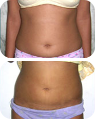 Liposuction in India