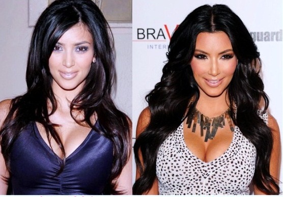 kim-kardashian-before-and-after_plastic_surgery