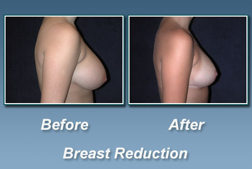 breast reduction in India