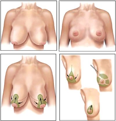 breast-reduction-before-and-after-d-to-b-photo-3