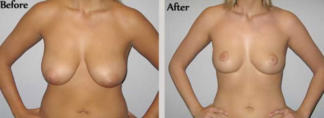Breast-Reduction-Cost