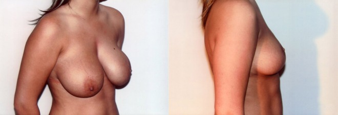 breast-reduction-lift