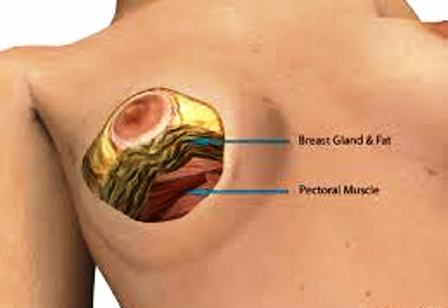 Breast Reduction in India