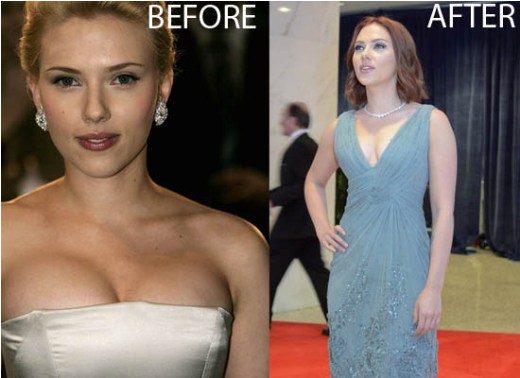 Breast Reduction in India